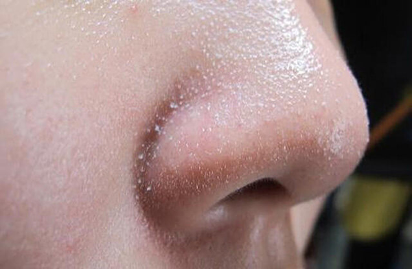 sợi bã nhờn ở mũi