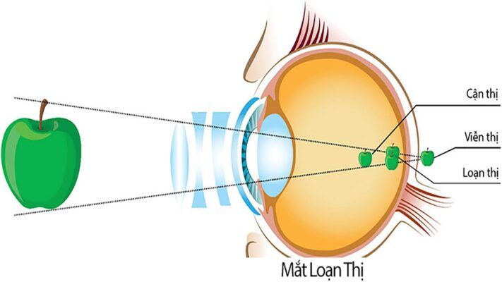 Rối loạn thị giác là một trong những triệu chứng của bại não