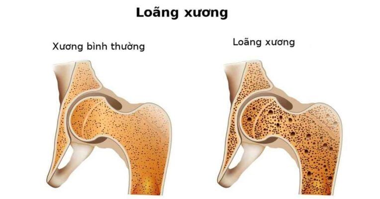 thiếu Vitamin D3K2 có thể dẫn đến loãng xương