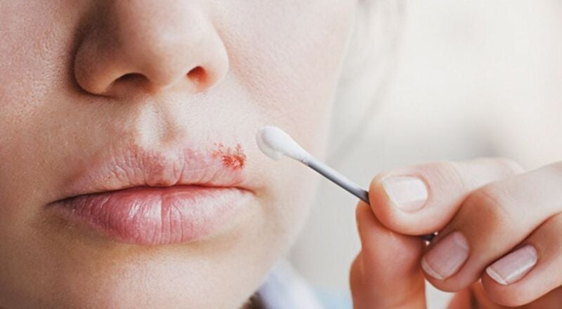 thuốc bôi điều trị herpes môi