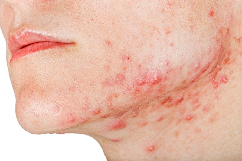 Mụn nội tiết kéo dài đặc biệt ở cằm, quai hàm