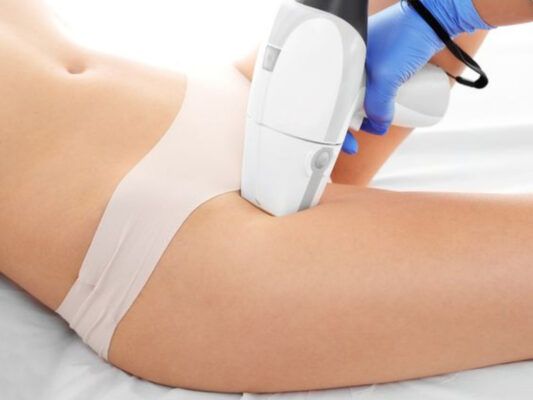triệt bằng phương pháp laser