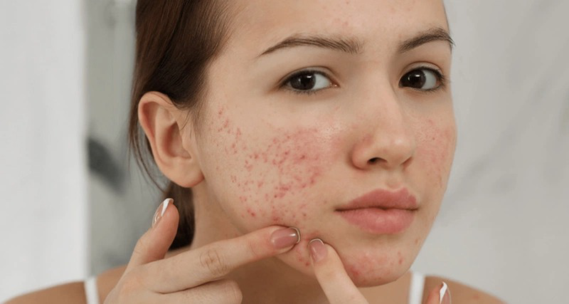 Tự nặn mụn bằng tay không sạch