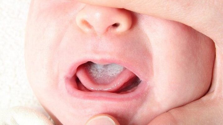 Nấm candida có nguy cơ lây từ mẹ sang con khi sinh thường
