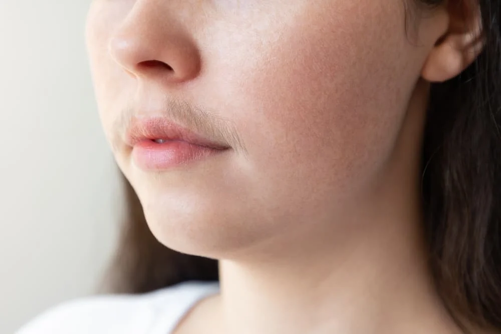 Dấu hiệu PCOS- Lông mọc nhiều ở ria mép