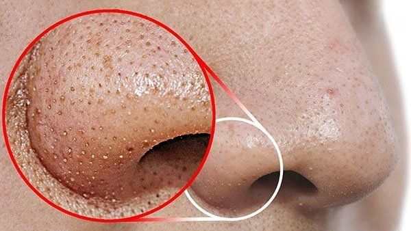 MỤN ĐẦU ĐEN Ở MŨI – KHÔNG PHẢI LỖI CỦA LỖ CHÂN LÔNG!