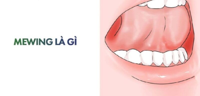 Vậy lợi ích mà Mewing mang đến là gì?
