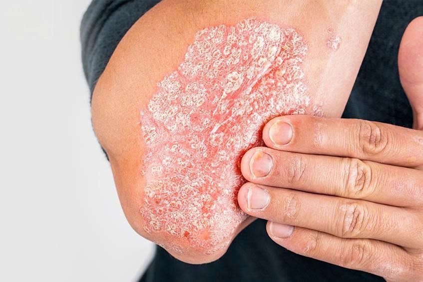 VẢY NẾN LÀ GÌ? VÌ SAO KHÓ KIỂM SOÁT?