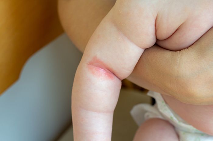 vì sao mùa hè trẻ dễ bị hăm da hơn?