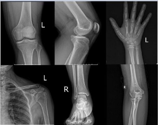 chụp x-quang các vị trí để biết xương đã đóng hay chưa