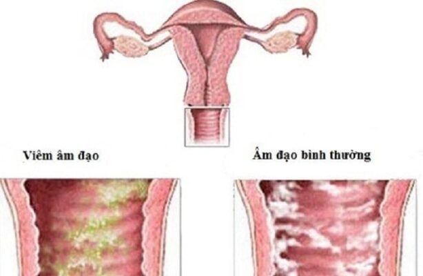 Viêm âm đạo là gì?