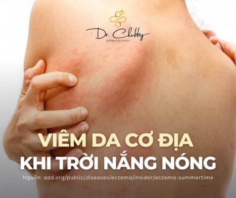 viêm da cơ địa