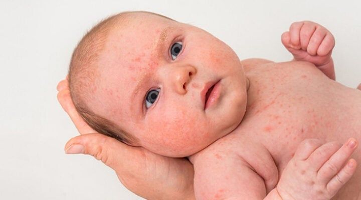 Viêm da cơ địa ở trẻ em - Chàm sữa
