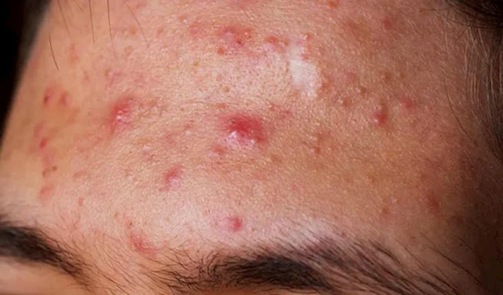 Viêm da do mụn có thể dẫn đến thâm đỏ