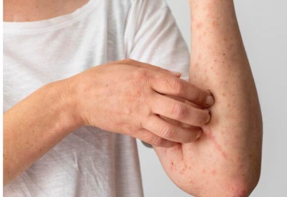 viêm da tiếp xúc, viêm da cơ địa