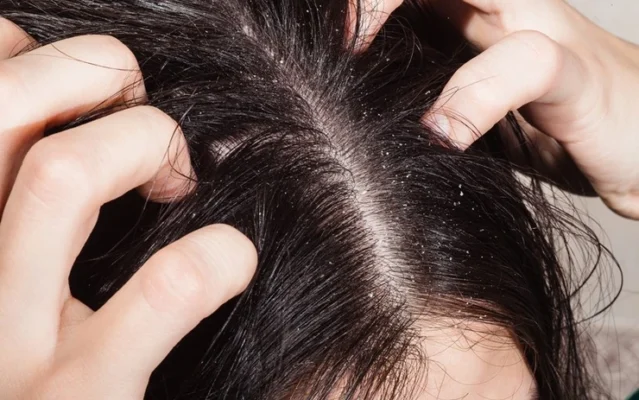 viêm da tiết bã ở da đầu