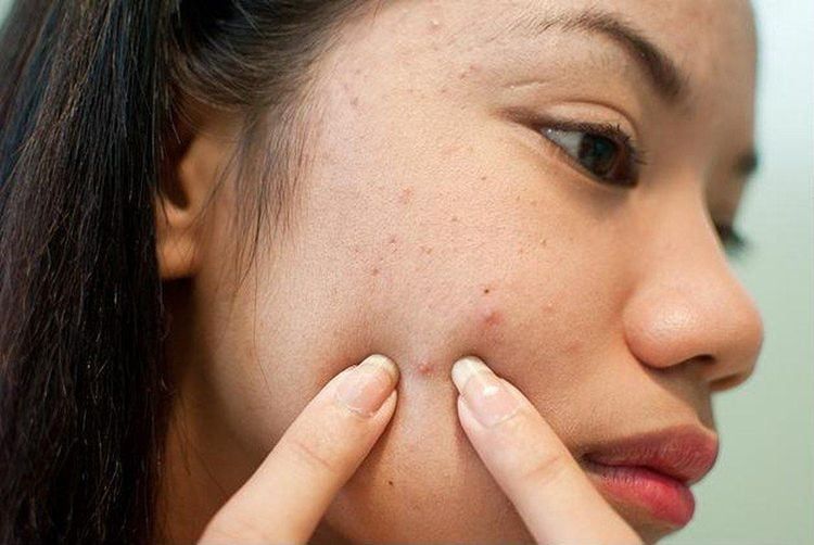 tự ý cào, bóp nặn mụn có thể gây thâm đỏ