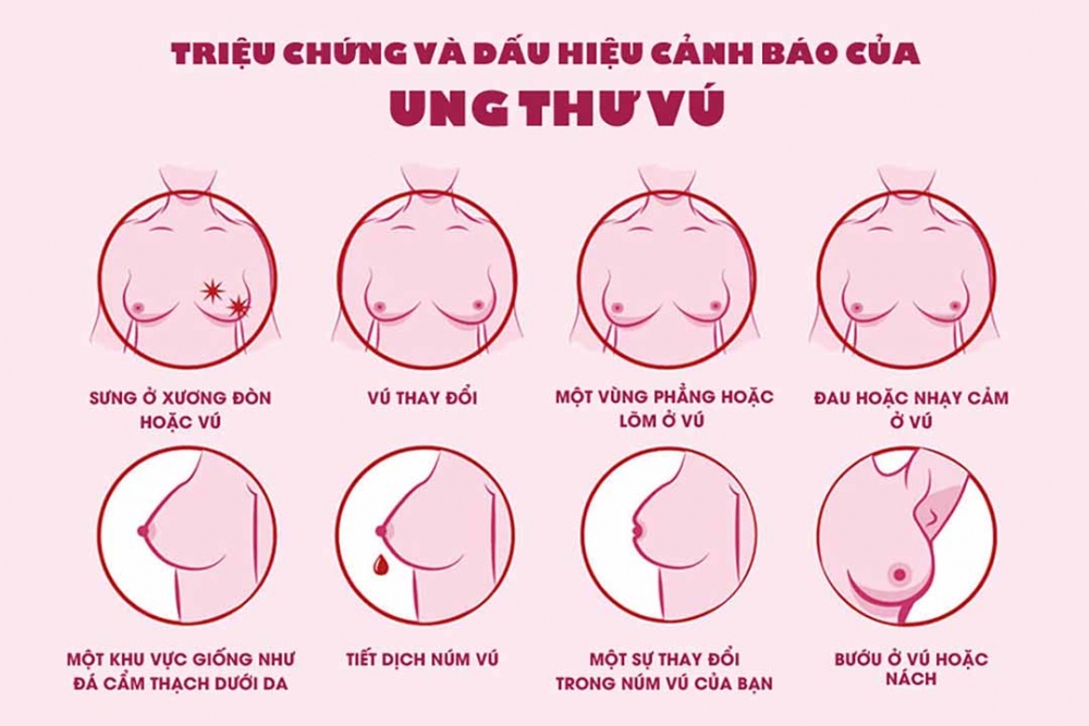 AI DỄ MẮC UNG THƯ VÚ VÀ CÁCH NHẬN BIẾT