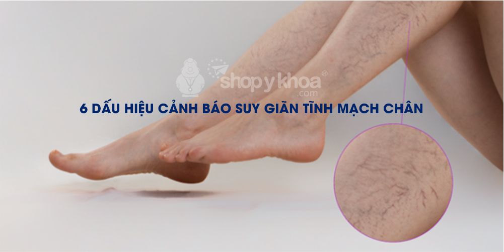6 dấu hiệu cảnh báo suy giãn tĩnh mạch chân