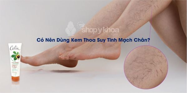 Có Nên Dùng Kem Thoa Suy Tĩnh Mạch Chân?