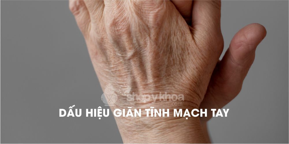 DẤU HIỆU GIÃN TĨNH MẠCH TAY