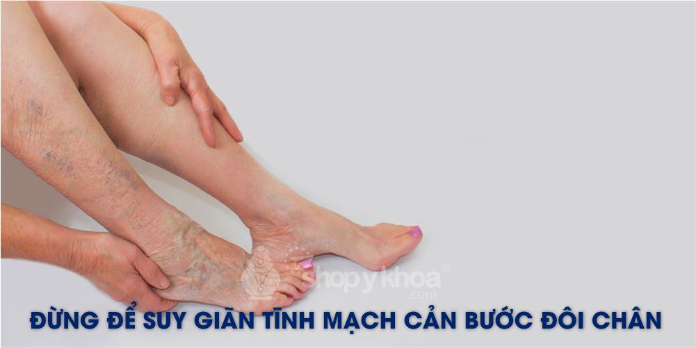 Đừng để suy giãn tĩnh mạch cản bước đôi chân