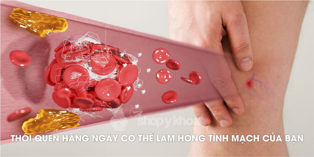 Thói quen hàng ngày có thể làm hỏng tĩnh mạch của bạn