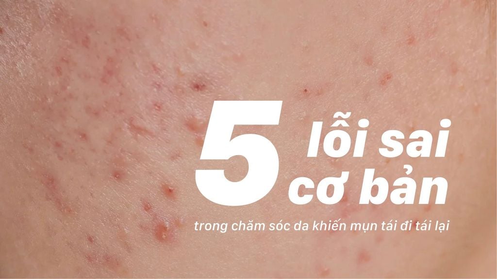 5 lỗi sai cơ bản trong chăm sóc da khiến mụn tái đi tái lại