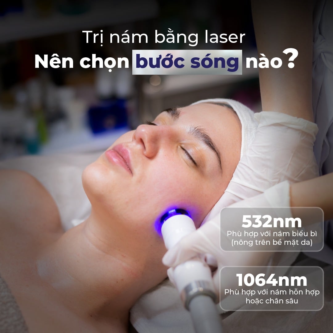 Trị nám bằng laser – nên chọn bước sóng nào, bao lâu mới có hiệu quả?