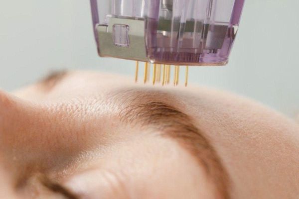 Phương pháp Meso: Giải pháp tối ưu trong điều trị và làm đẹp